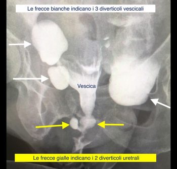 Diverticoli uretrali - Fig. 5