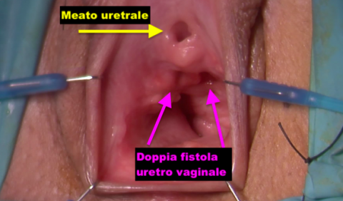 Fistole uretro-vaginali - Fig. 2