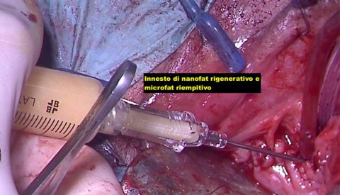 Innesto Nanofat rigenerativo - Fig. 100