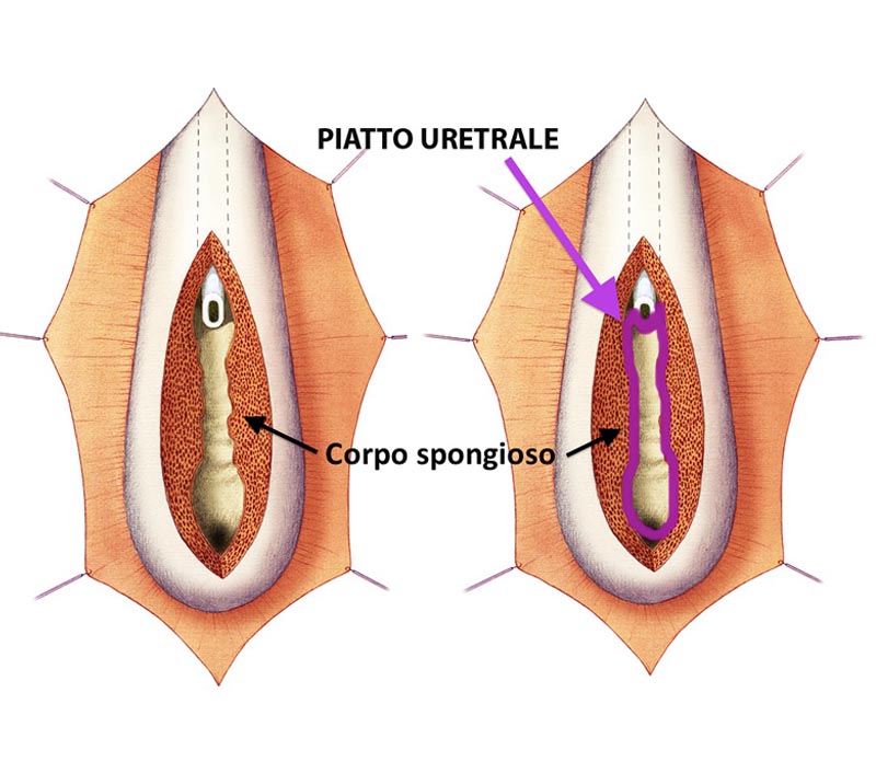 Fig. 5 - Piatto-uretrale