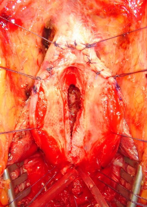 Rimozione stent uretrale - Fig. 6