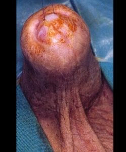 Lichen sclerosus - Fig. 2