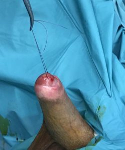 Lichen sclerosus - Fig. 7