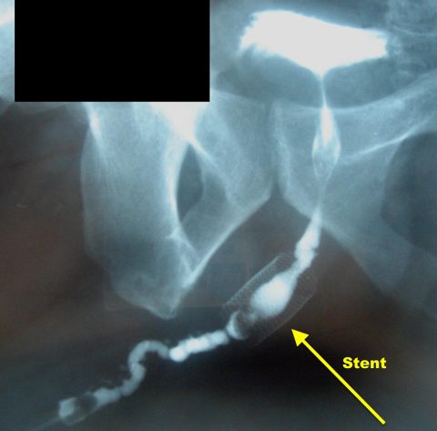 Rimozione stent uretrale - Fig. 1